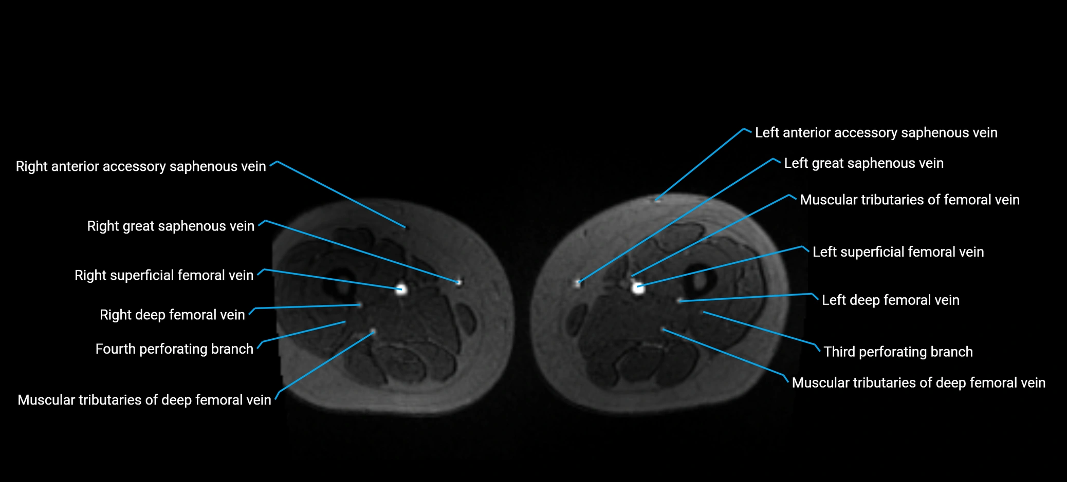 MRV abdomen pelvis & lower limb axial cross sectional anatomy labelled MRI image 272 (1).webp